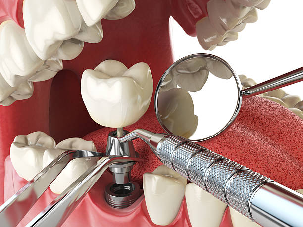 Best Emergency Root Canal Treatment in West Branch, MI